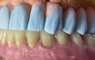 coronas de metal porcelana