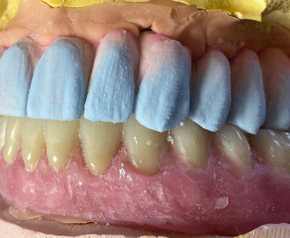 coronas de metal porcelana