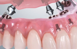 prótesis híbridas de composite