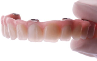 prótesis híbridas de composite