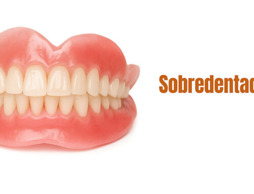 Sobredentaduras personalizadas: solución cómoda y funcional